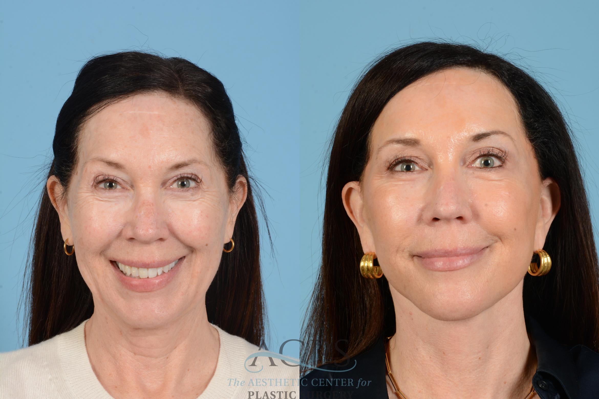 Before & After Fat Grafting Case 1568 Front View in Houston, TX