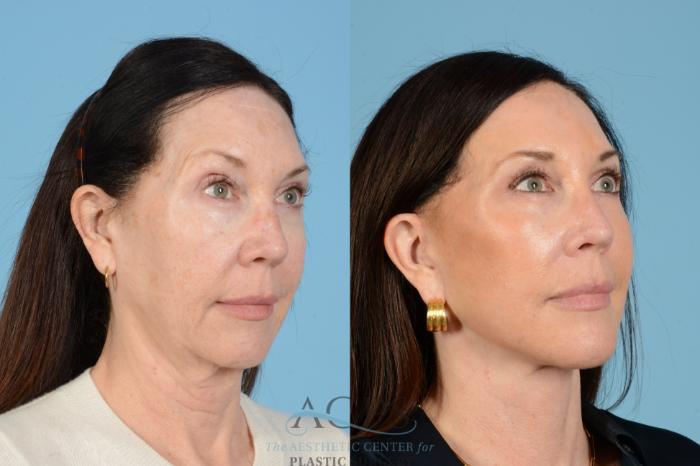 Before & After Fat Grafting Case 1568 Left Oblique View in Houston, TX