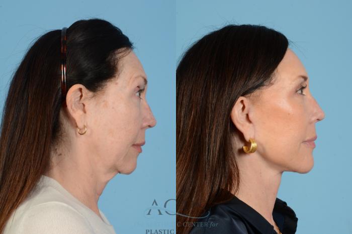 Before & After Fat Grafting Case 1568 Left Side View in Houston, TX