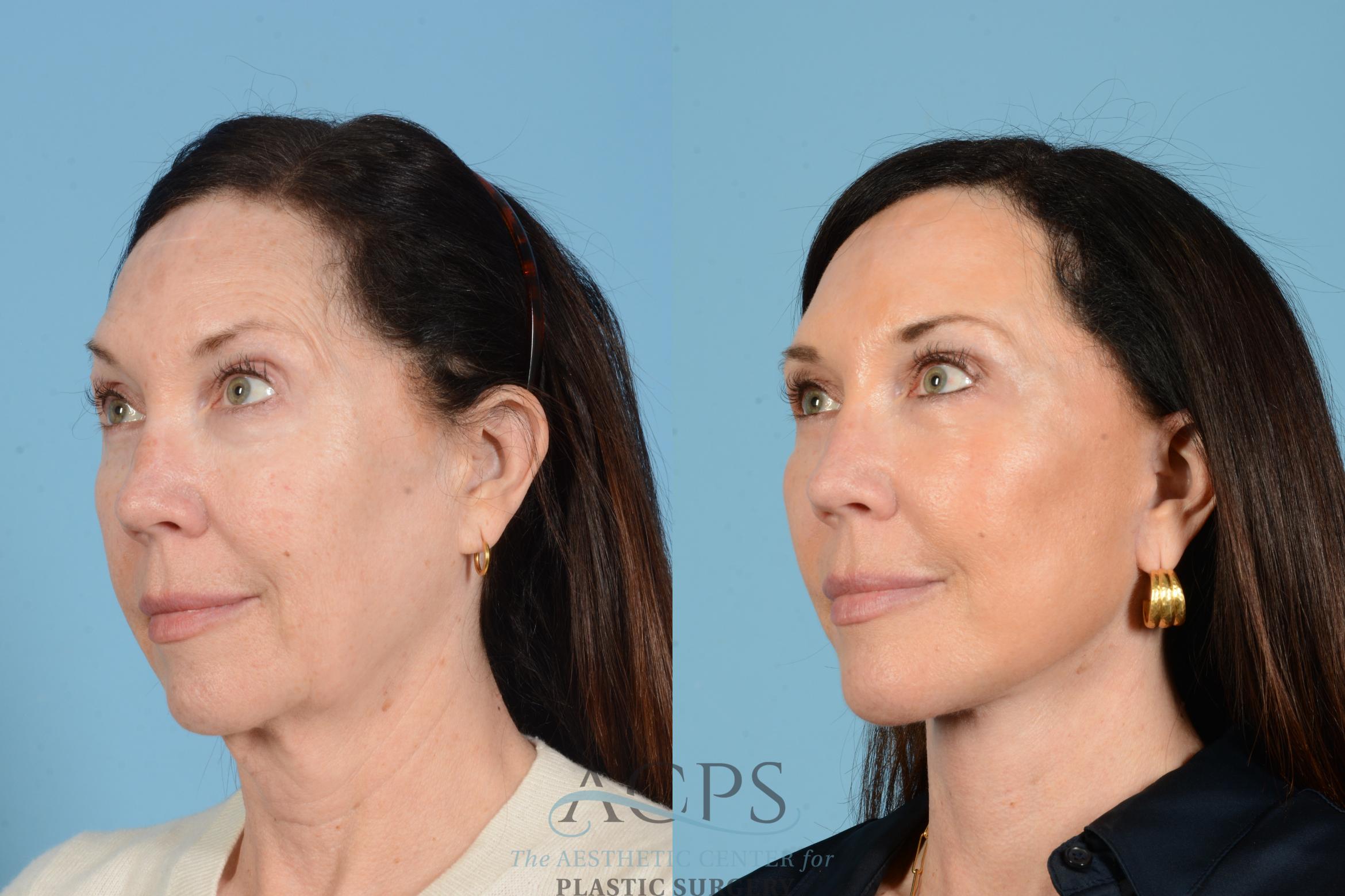 Before & After Fat Grafting Case 1568 Right Oblique View in Houston, TX