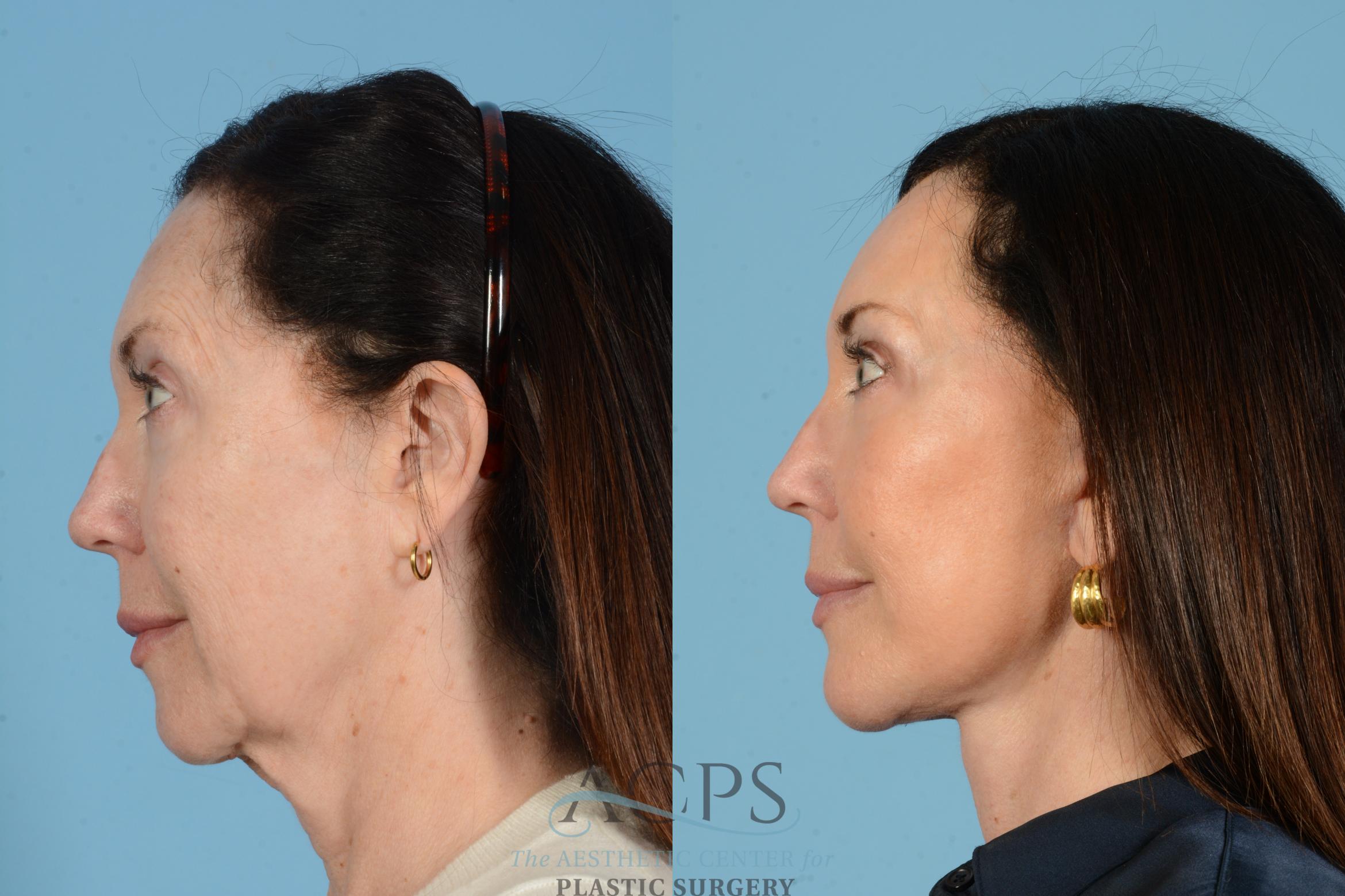 Before & After Fat Grafting Case 1568 Right Side View in Houston, TX