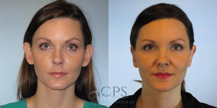 Before & After Otoplasty Case 1364 Front View: View in Houston, TX