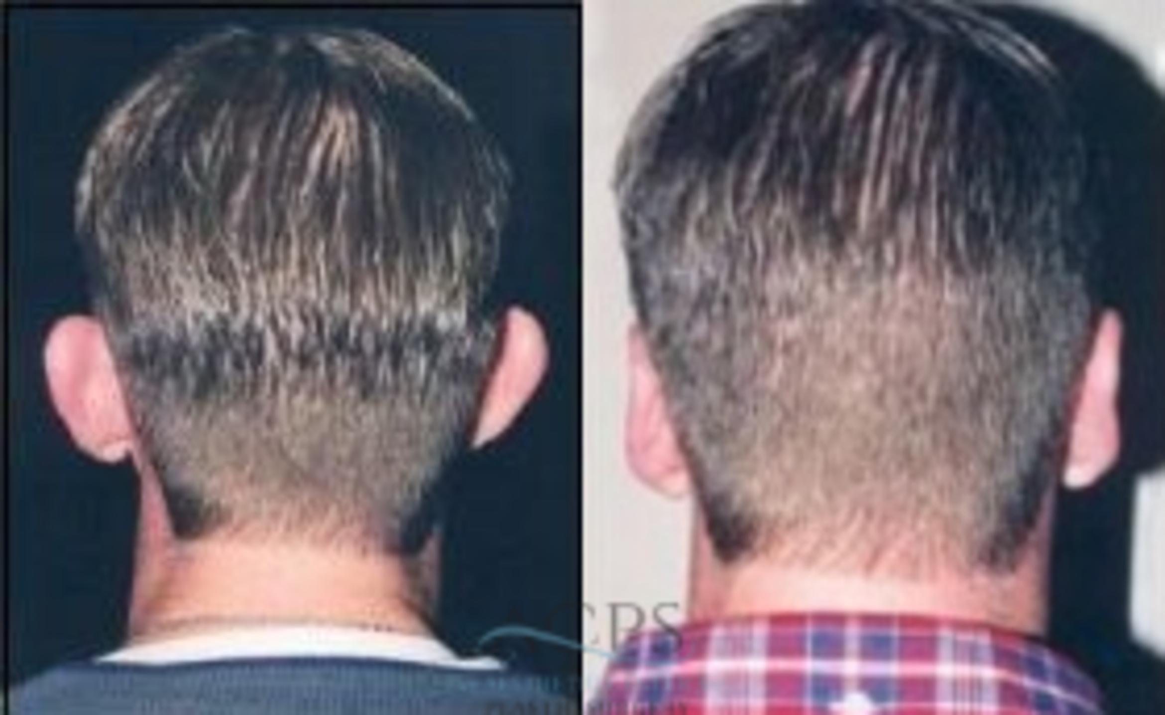 Before & After Otoplasty Case 1365 Rear View: View in Houston, TX