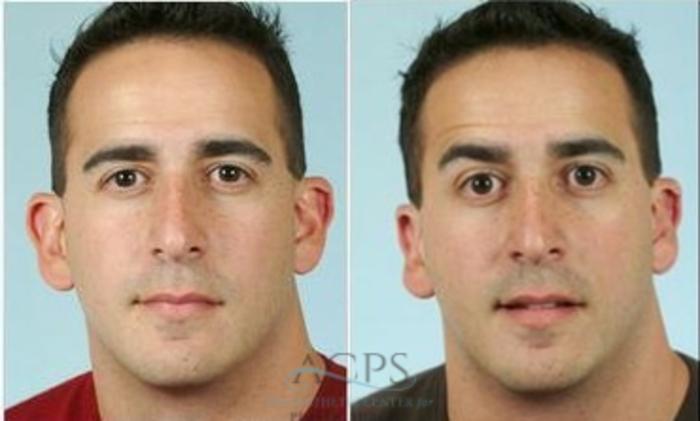 Before & After Otoplasty Case 1366 Front View: View in Houston, TX
