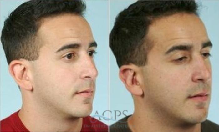Before & After Otoplasty Case 1366 Oblique View: View in Houston, TX
