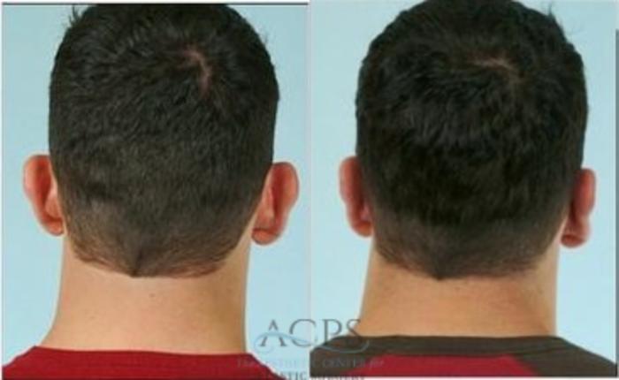 Before & After Otoplasty Case 1366 Rear View: View in Houston, TX