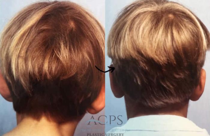 Before & After Otoplasty Case 1449 Back View in Houston, TX