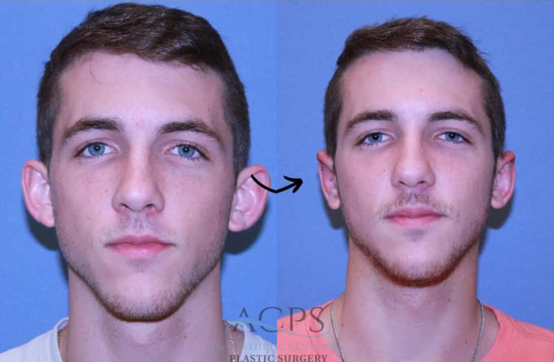 Before & After Otoplasty Case 1450 Front View in Houston, TX