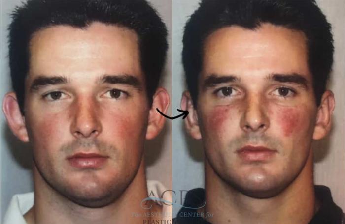 Before & After Otoplasty Case 1451 Front View in Houston, TX