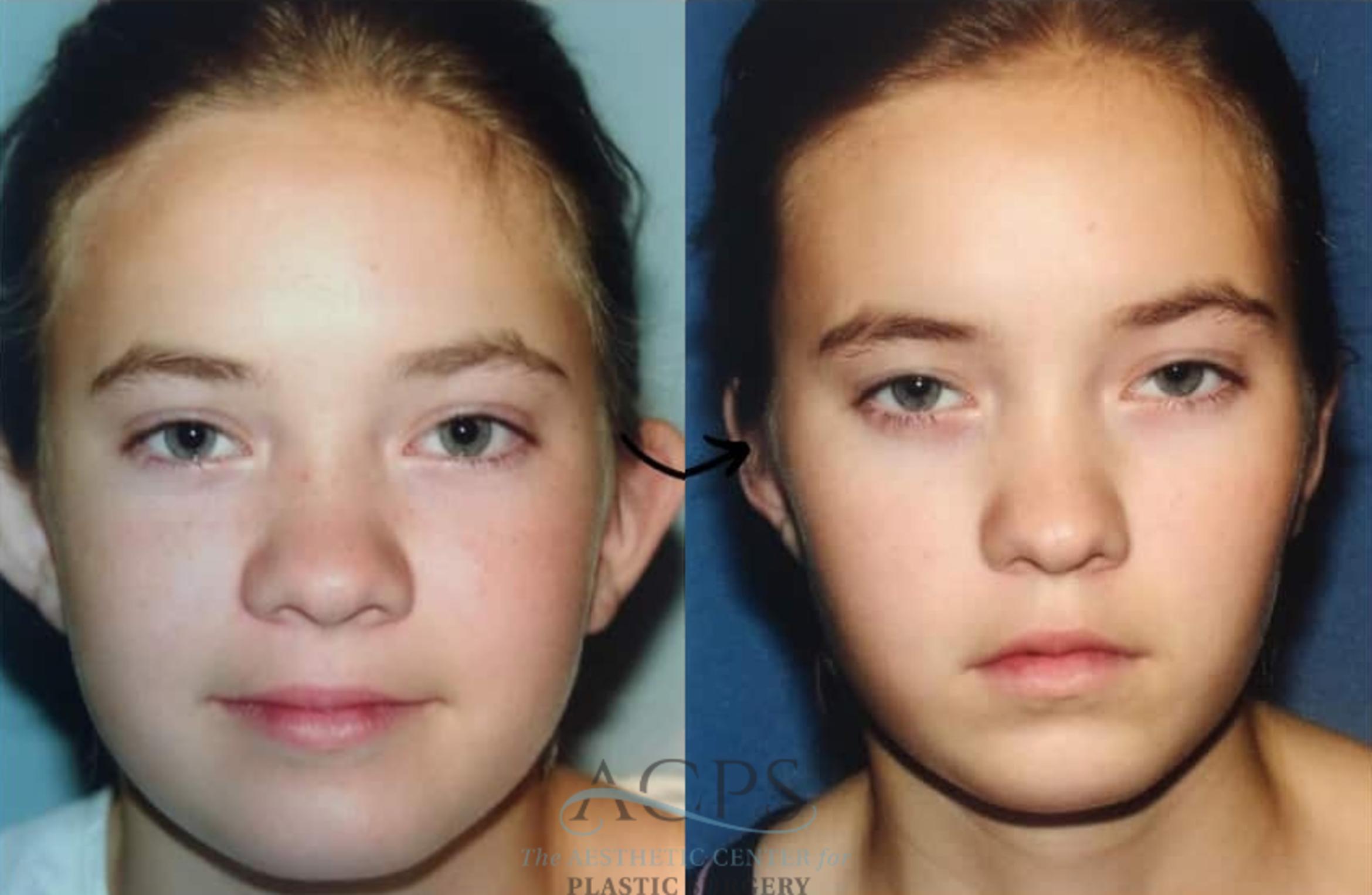 Before & After Otoplasty Case 1452 Front View in Houston, TX