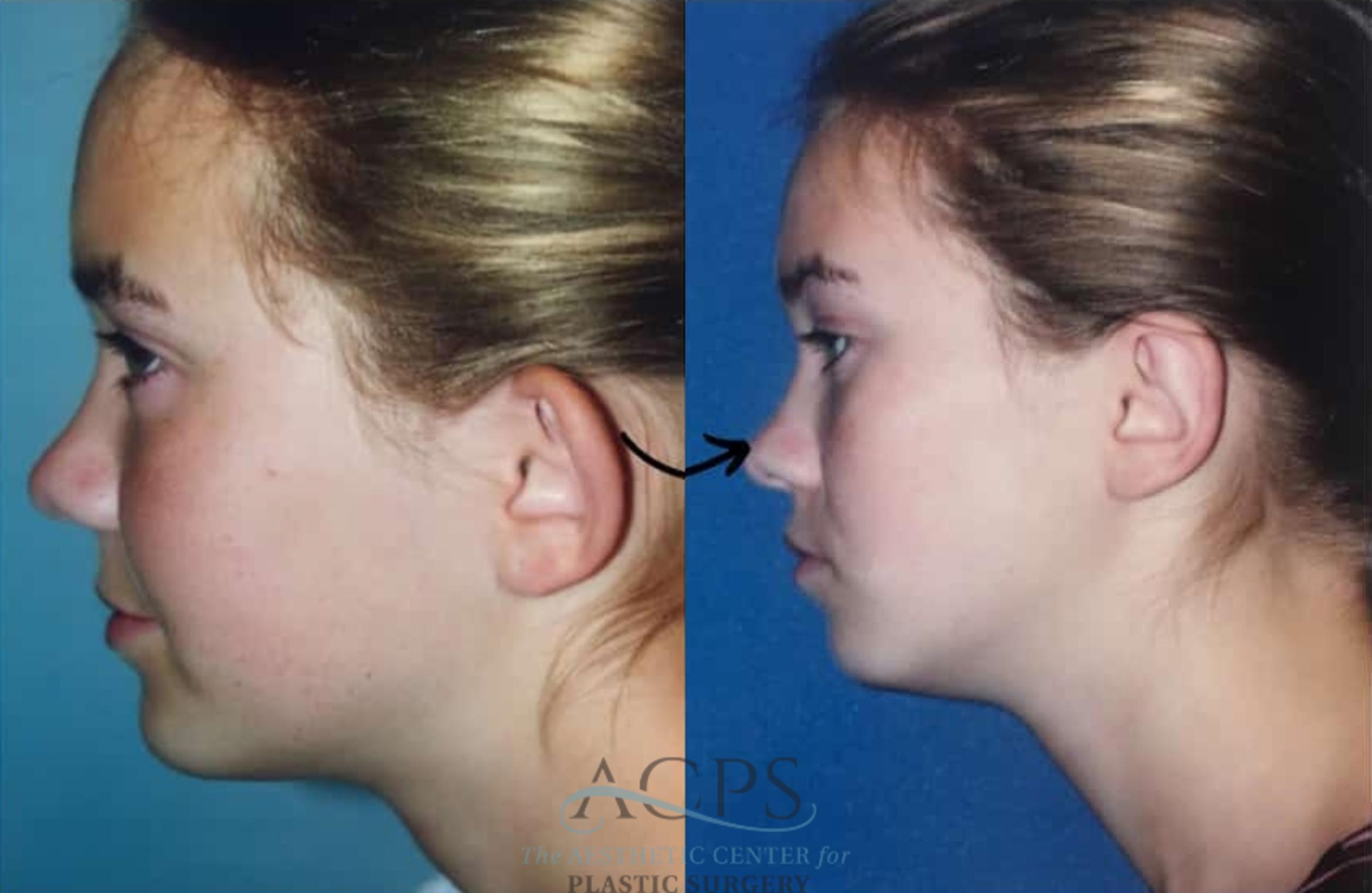 Before & After Otoplasty Case 1453 Left Side View in Houston, TX