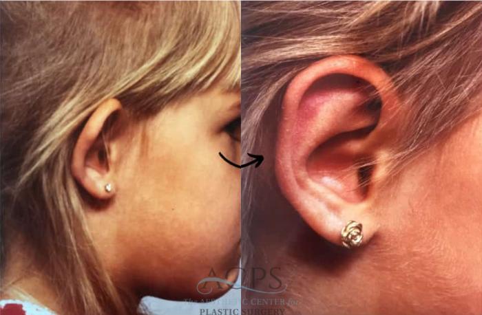 Before & After Otoplasty Case 1454 Right Side View in Houston, TX