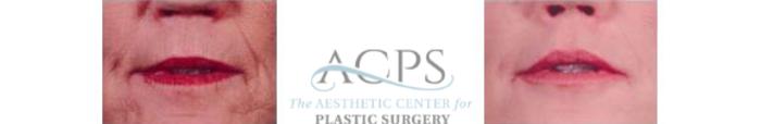 Before & After Restylane Case 1430 Front View: View in Houston, TX
