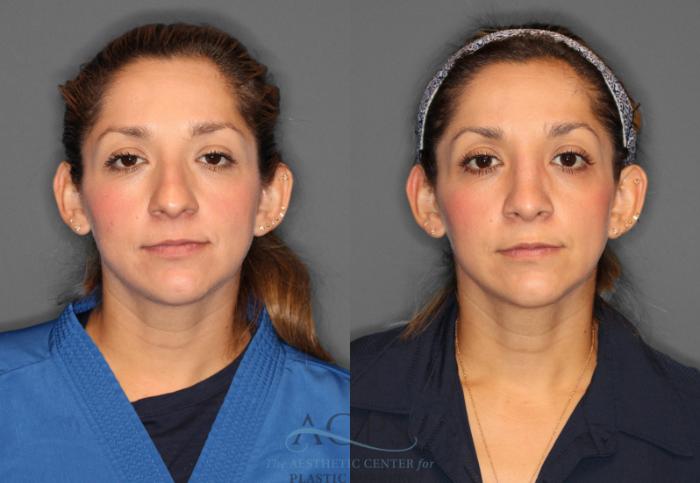 Before & After Rhinoplasty Case 1198 Front View: View in Houston, TX