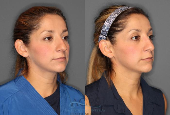 Before & After Rhinoplasty Case 1198 Oblique View: View in Houston, TX