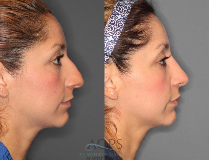 Before & After Rhinoplasty Case 1198 Side View: View in Houston, TX