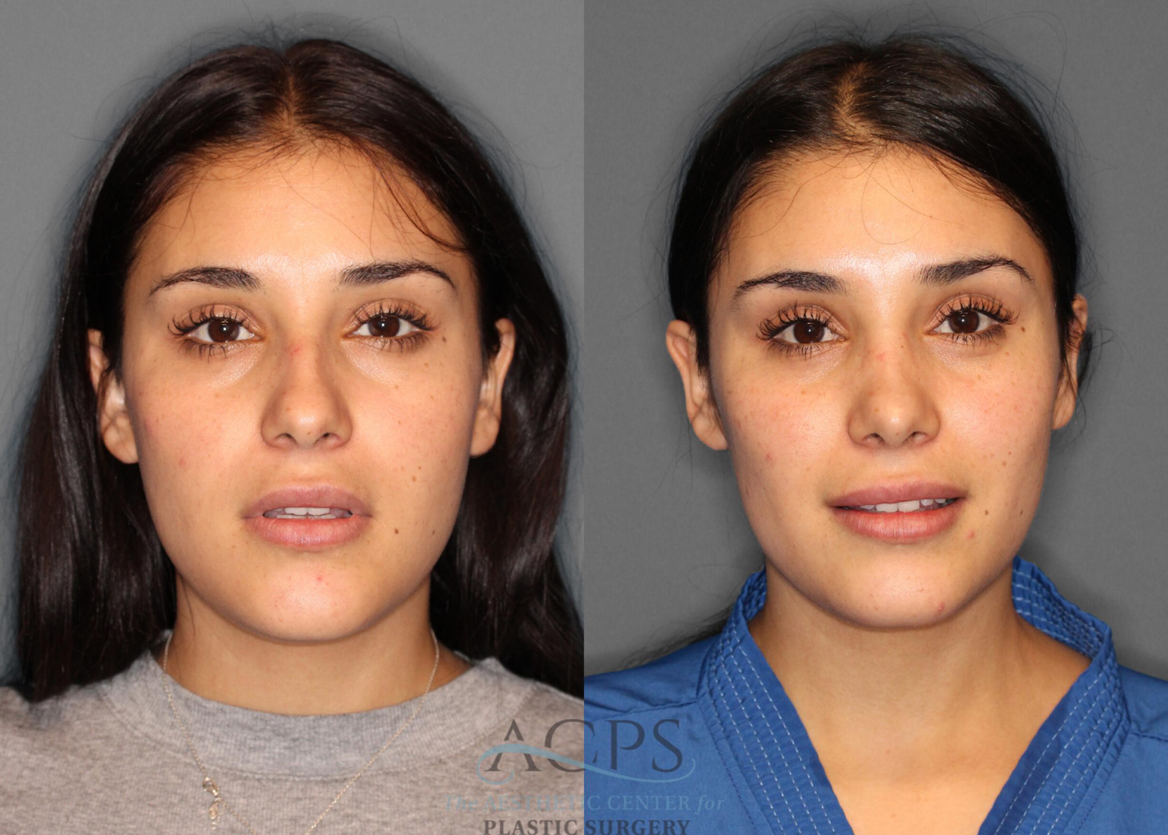 Before & After Rhinoplasty Case 1199 Front View: View in Houston, TX