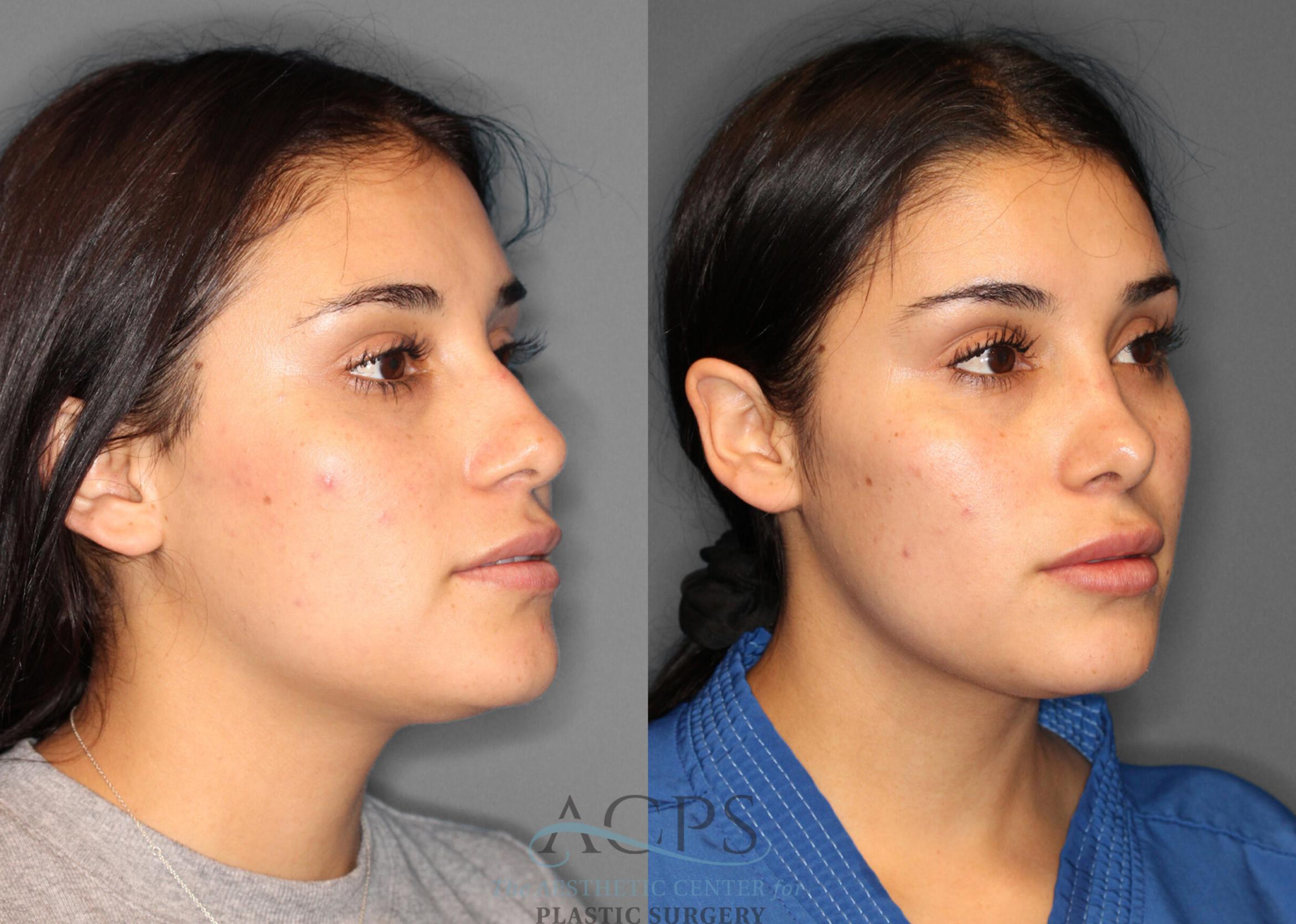 Before & After Rhinoplasty Case 1199 Oblique View: View in Houston, TX