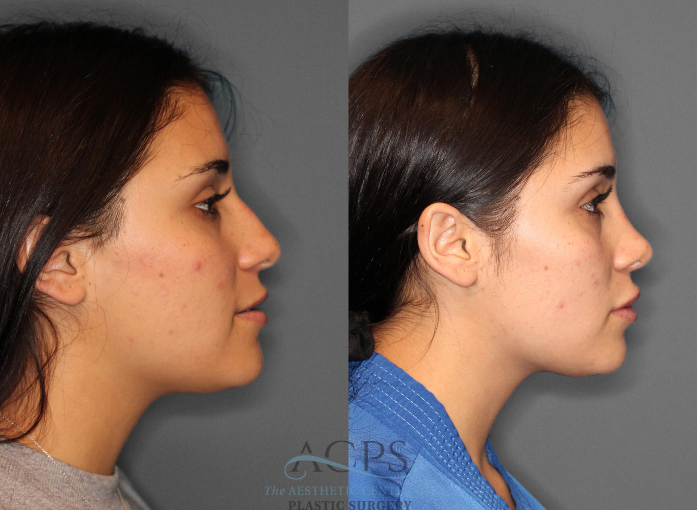 Before & After Rhinoplasty Case 1199 Side View: View in Houston, TX