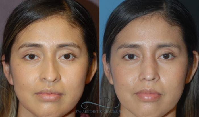 Before & After Rhinoplasty Case 1200 Front View: View in Houston, TX