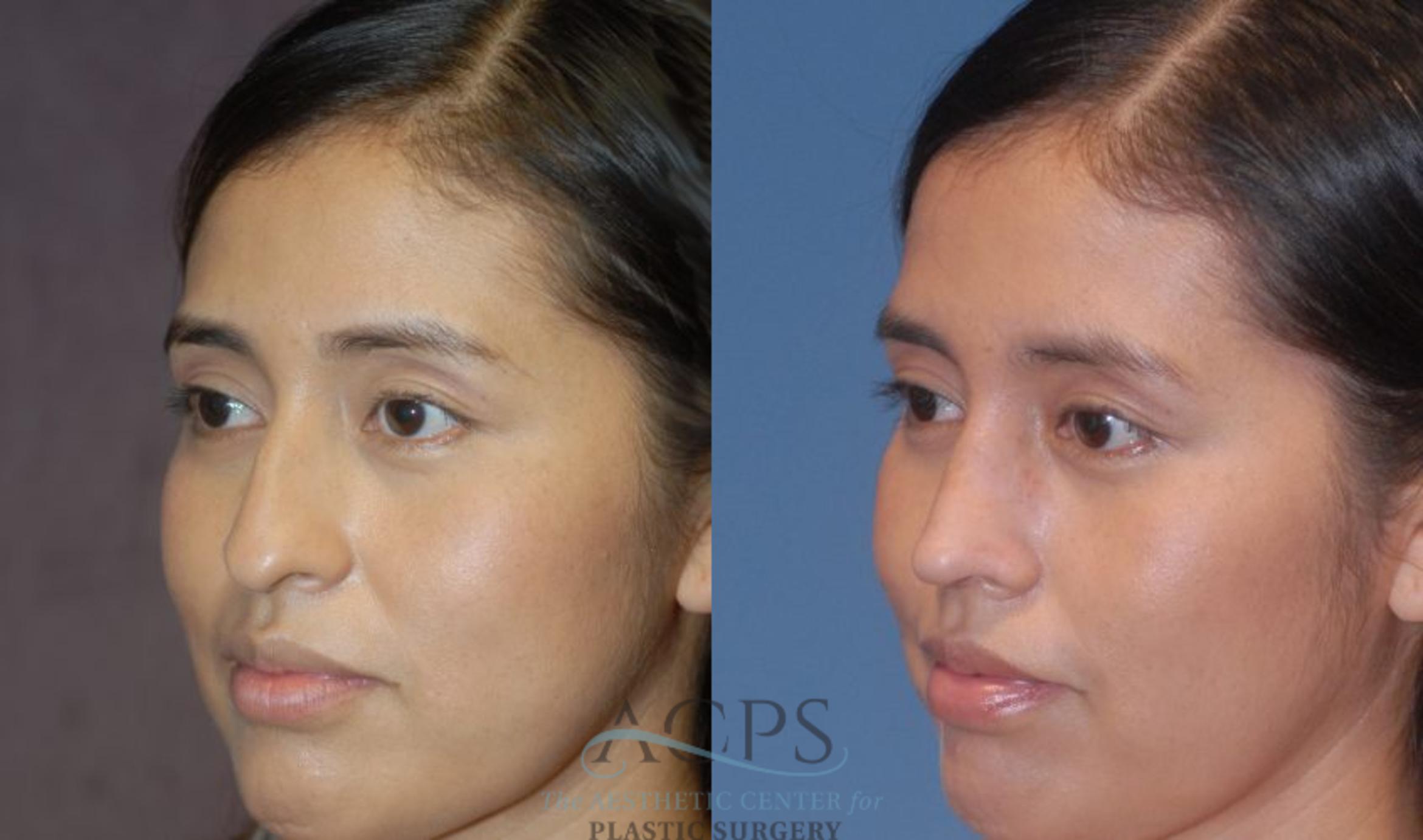 Before & After Rhinoplasty Case 1200 Left Oblique View: View in Houston, TX