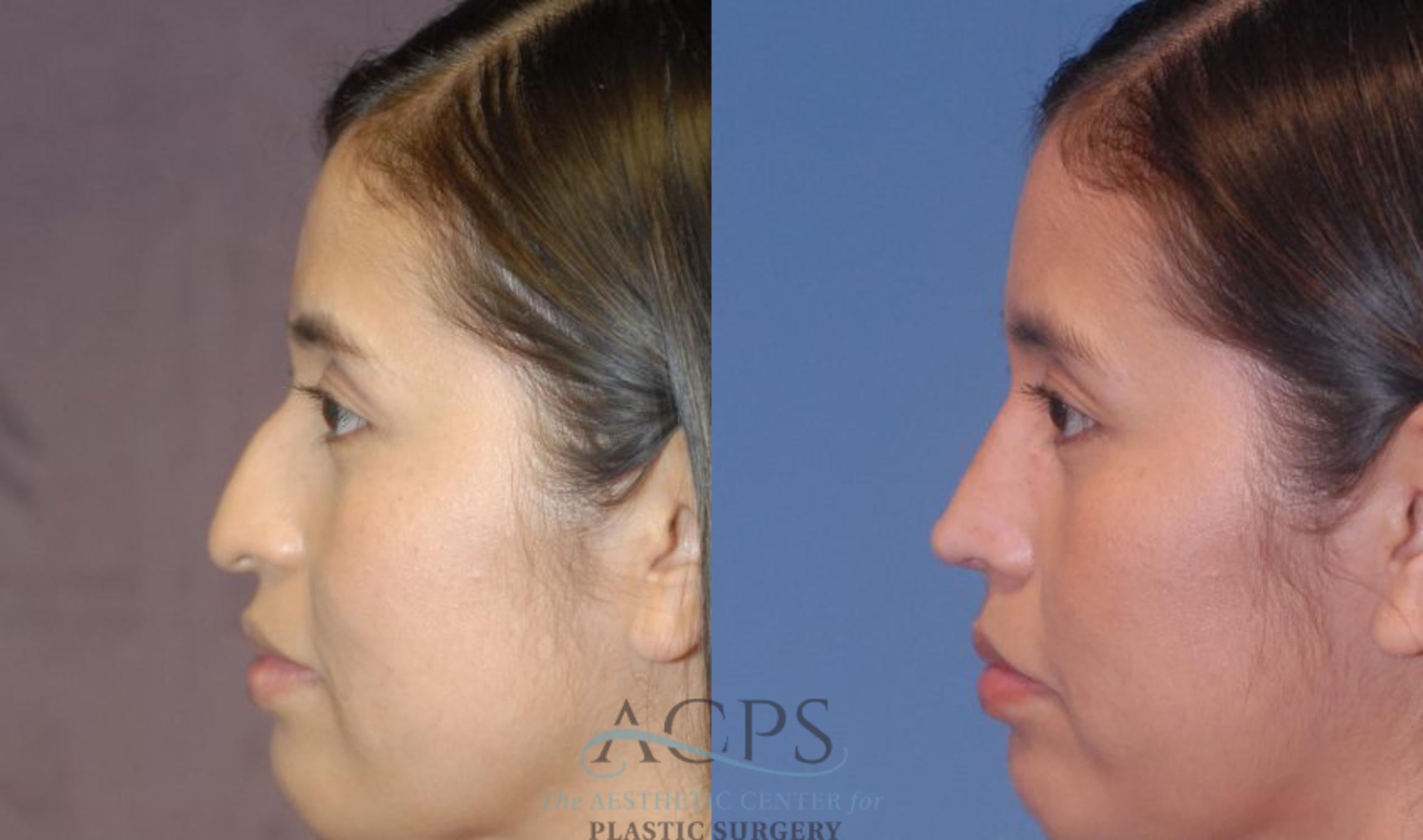 Before & After Rhinoplasty Case 1200 Left Side View: View in Houston, TX