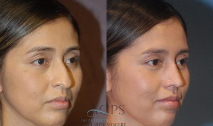 Before & After Rhinoplasty Case 1200 Oblique View: View in Houston, TX