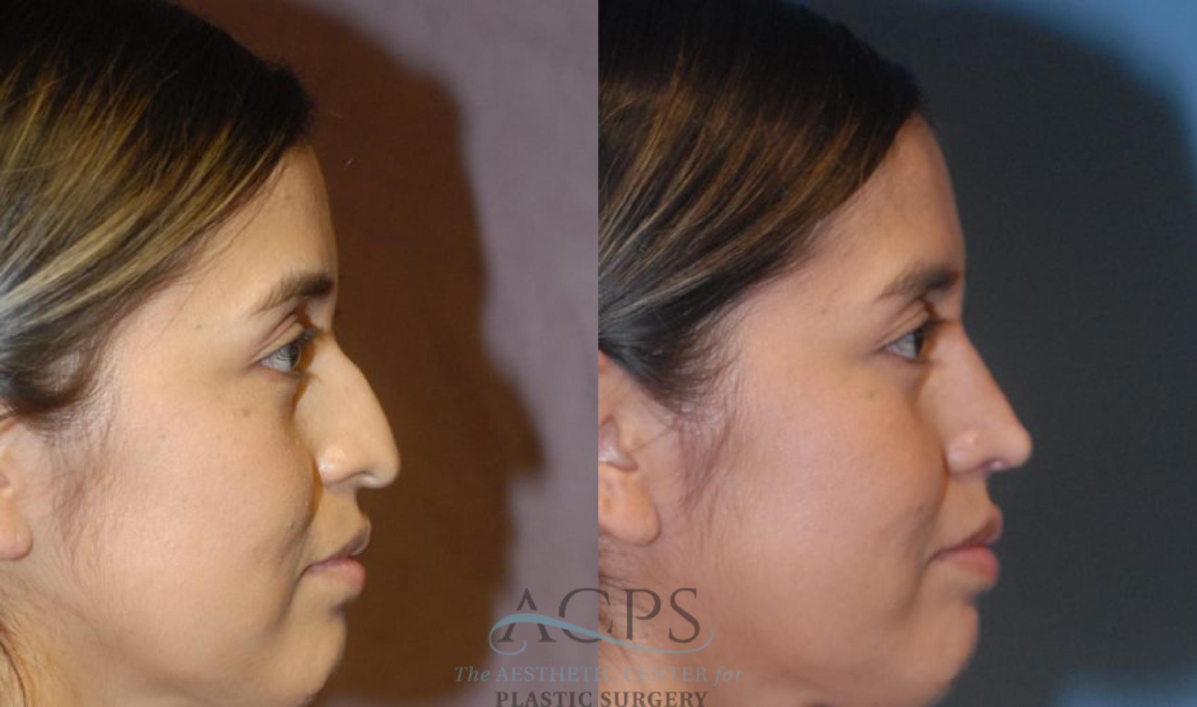 Before & After Rhinoplasty Case 1200 Side View: View in Houston, TX