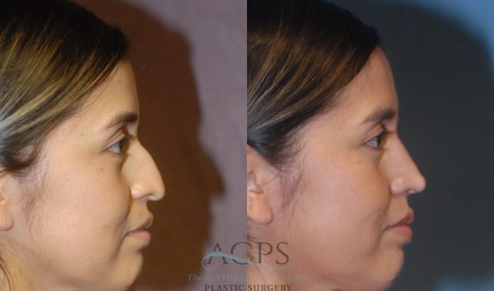 Before & After Rhinoplasty Case 1200 Side View: View in Houston, TX