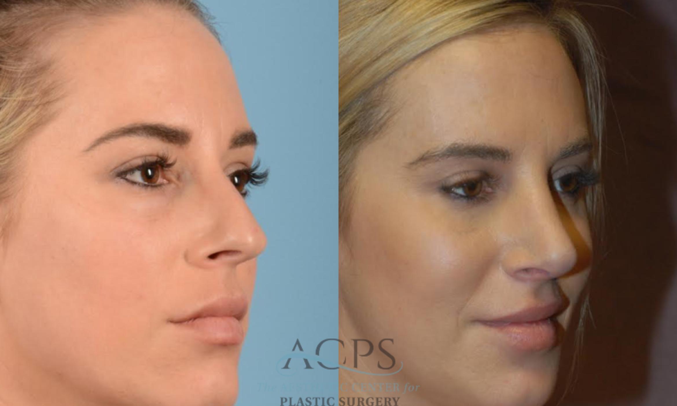 Before & After Rhinoplasty Case 1201 Oblique View: View in Houston, TX