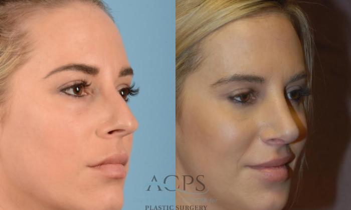 Before & After Rhinoplasty Case 1201 Oblique View: View in Houston, TX