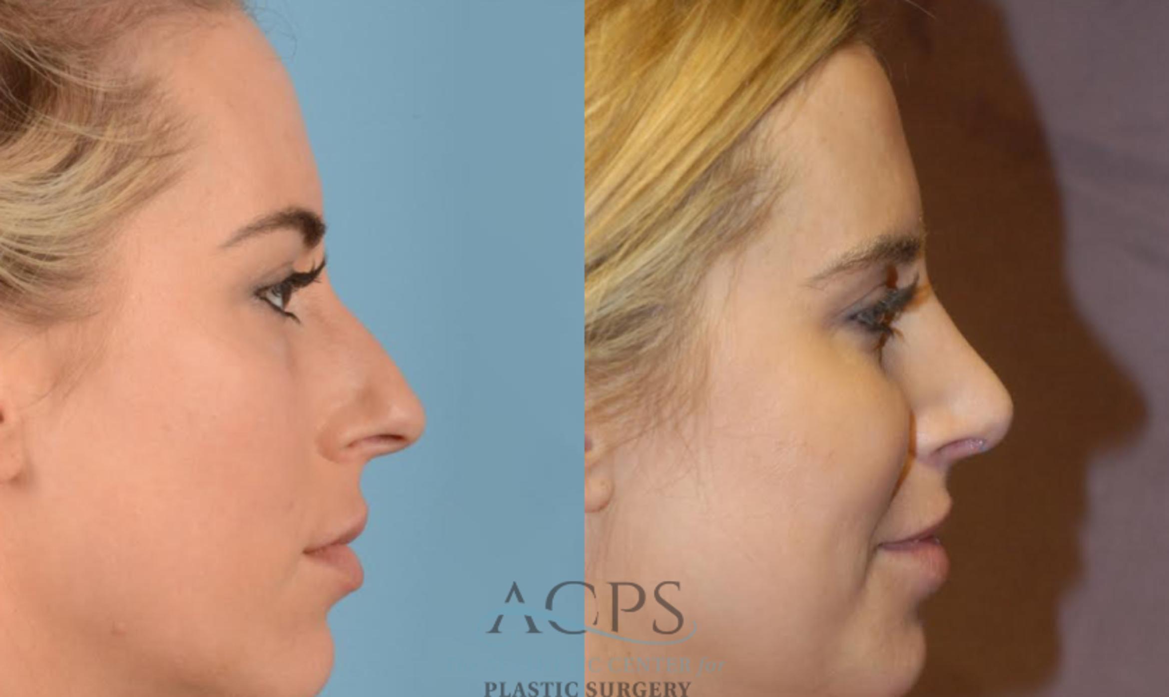 Before & After Rhinoplasty Case 1201 Side View: View in Houston, TX