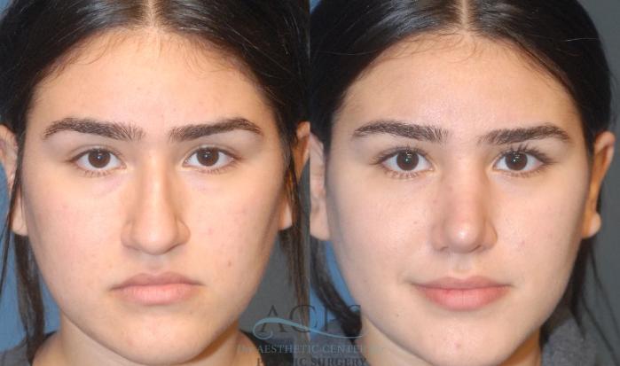 Before & After Rhinoplasty Case 1202 Front View: View in Houston, TX