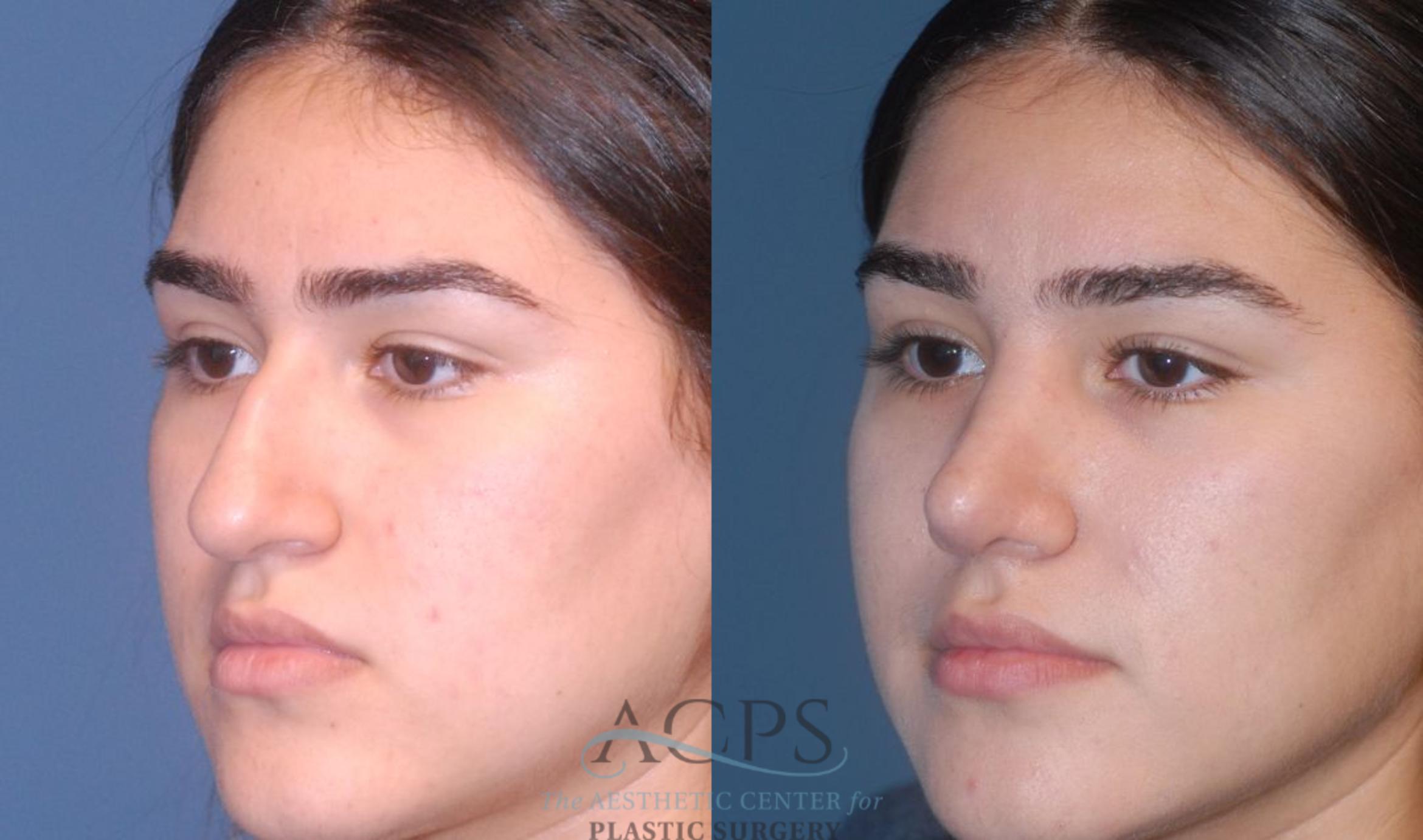 Before & After Rhinoplasty Case 1202 Left Oblique View: View in Houston, TX