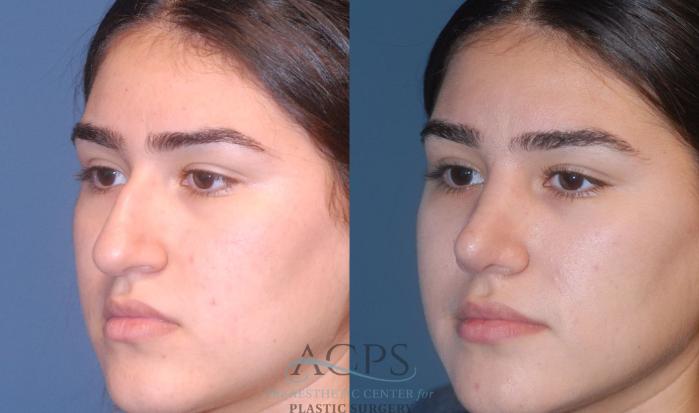 Before & After Rhinoplasty Case 1202 Left Oblique View: View in Houston, TX