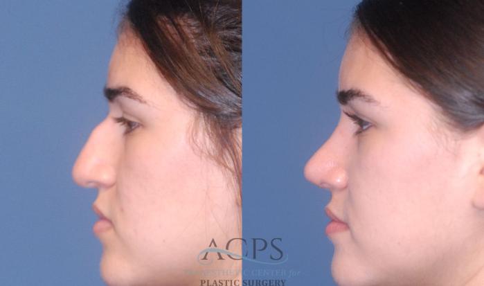 Before & After Rhinoplasty Case 1202 Left Side View: View in Houston, TX