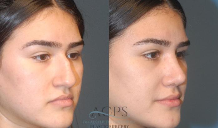 Before & After Rhinoplasty Case 1202 Oblique View: View in Houston, TX