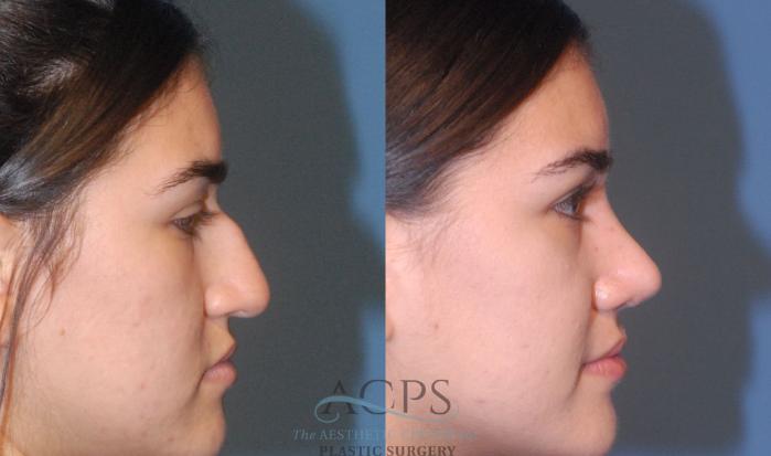 Before & After Rhinoplasty Case 1202 Right Side View: View in Houston, TX