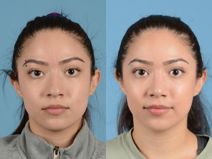 Before & After Rhinoplasty Case 1203 Front View: View in Houston, TX