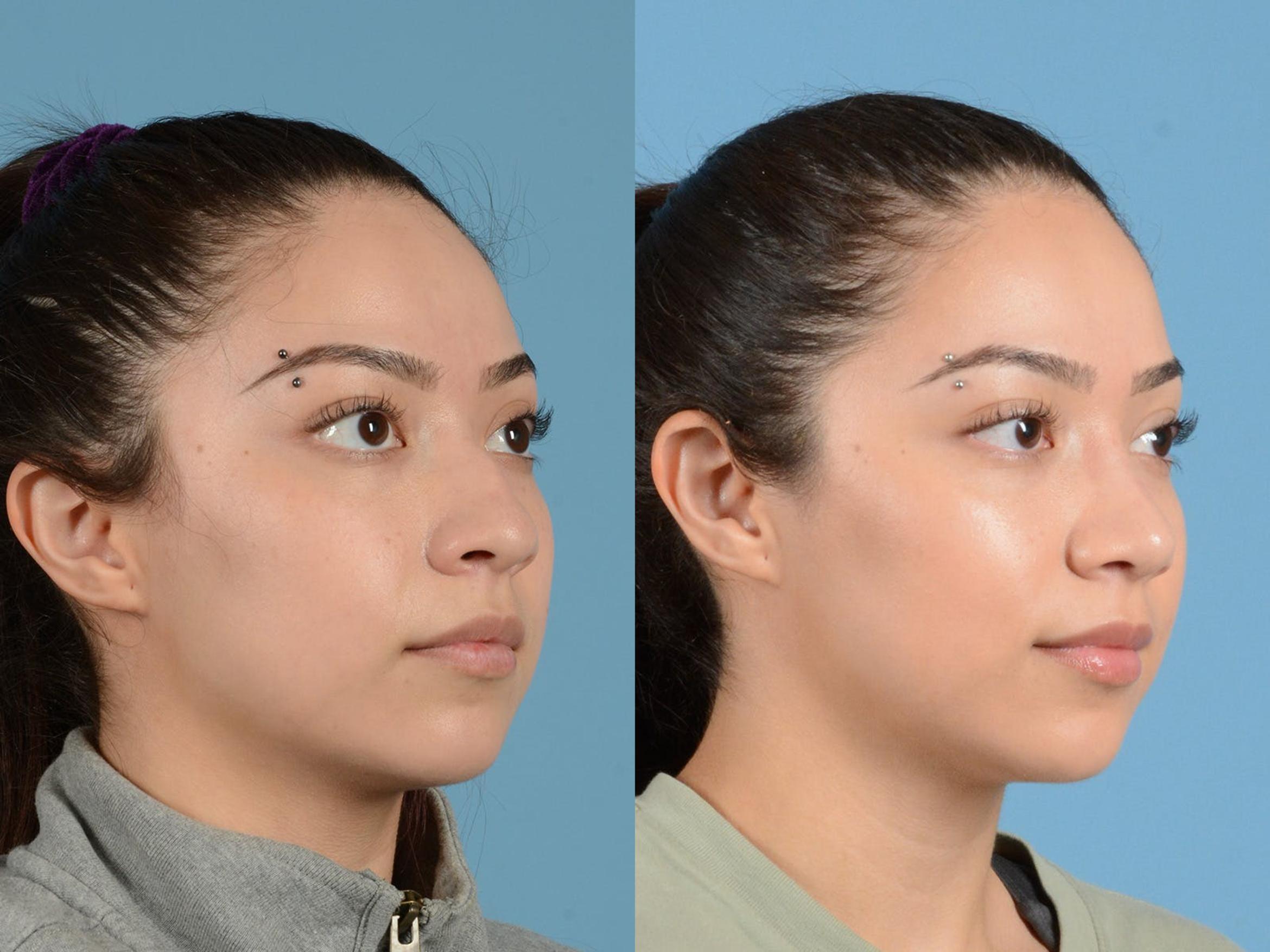 Before & After Rhinoplasty Case 1203 Oblique View: View in Houston, TX