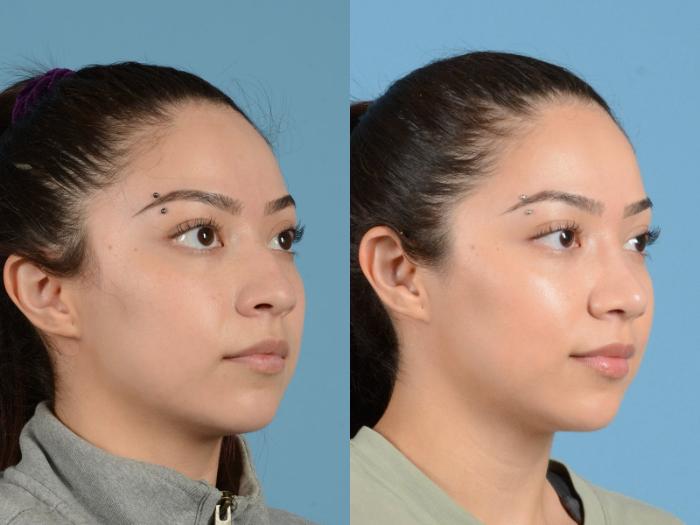 Before & After Rhinoplasty Case 1203 Oblique View: View in Houston, TX