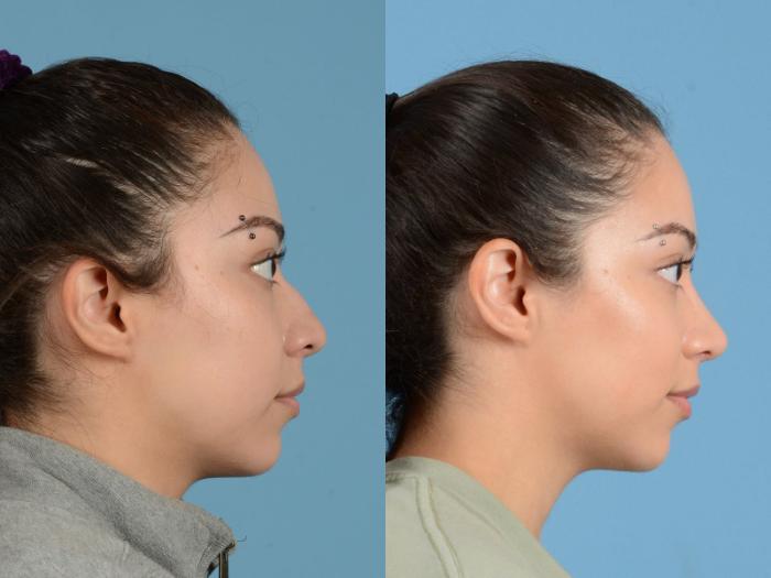 Before & After Rhinoplasty Case 1203 Side View: View in Houston, TX