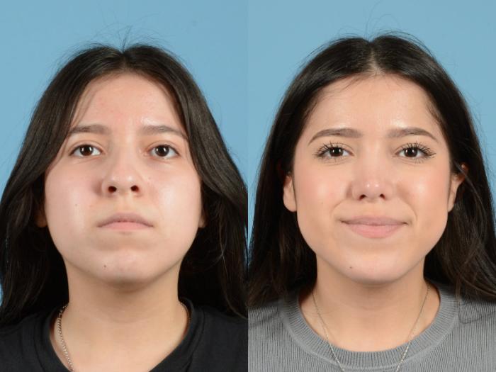 Before & After Rhinoplasty Case 1204 Front View: View in Houston, TX