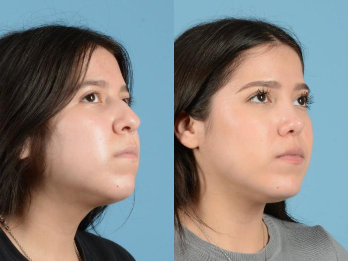 Before & After Rhinoplasty Case 1204 Oblique View: View in Houston, TX