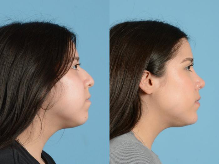 Before & After Rhinoplasty Case 1204 Side View: View in Houston, TX
