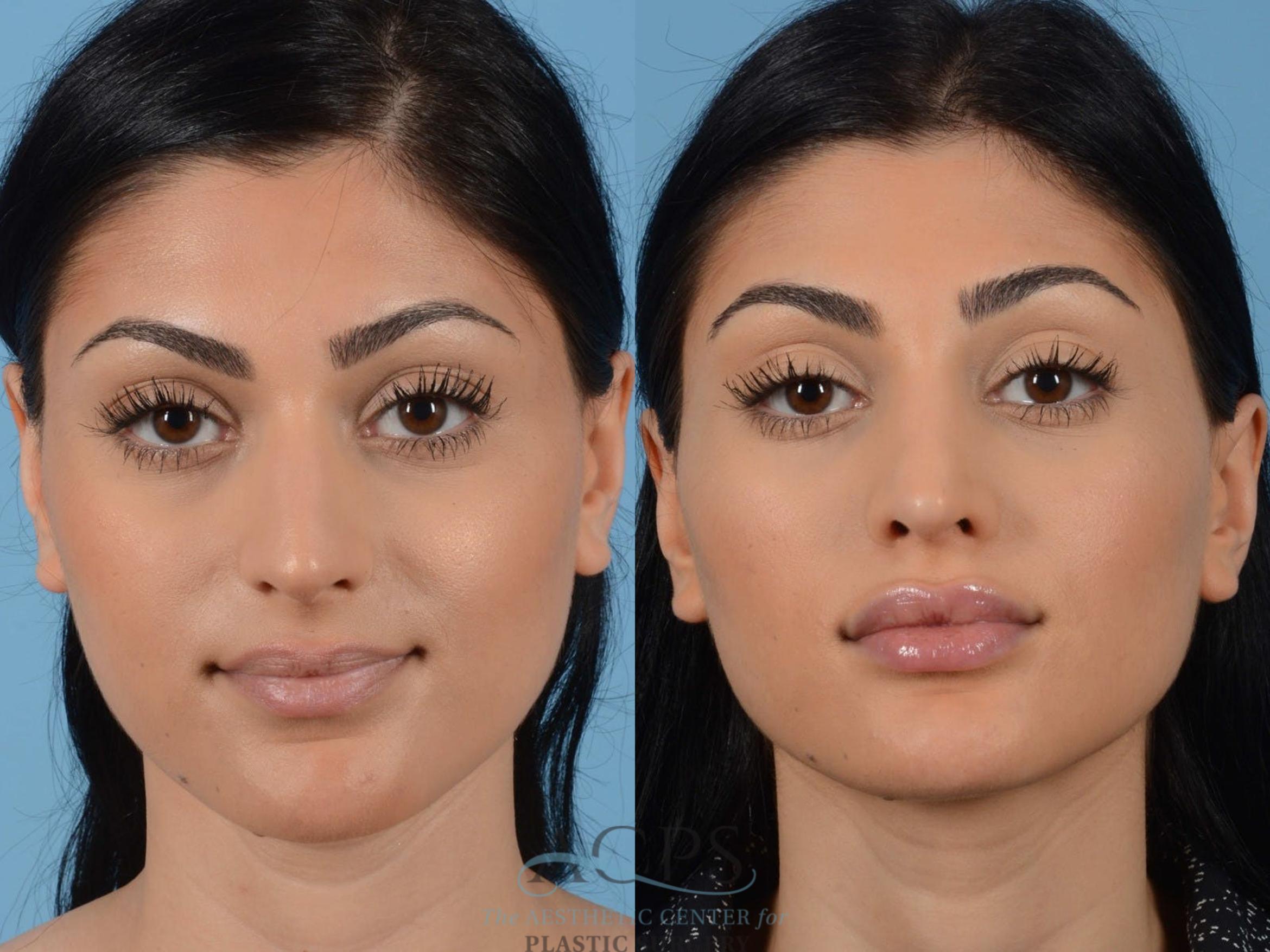 Before & After Rhinoplasty Case 1205 Front View: View in Houston, TX