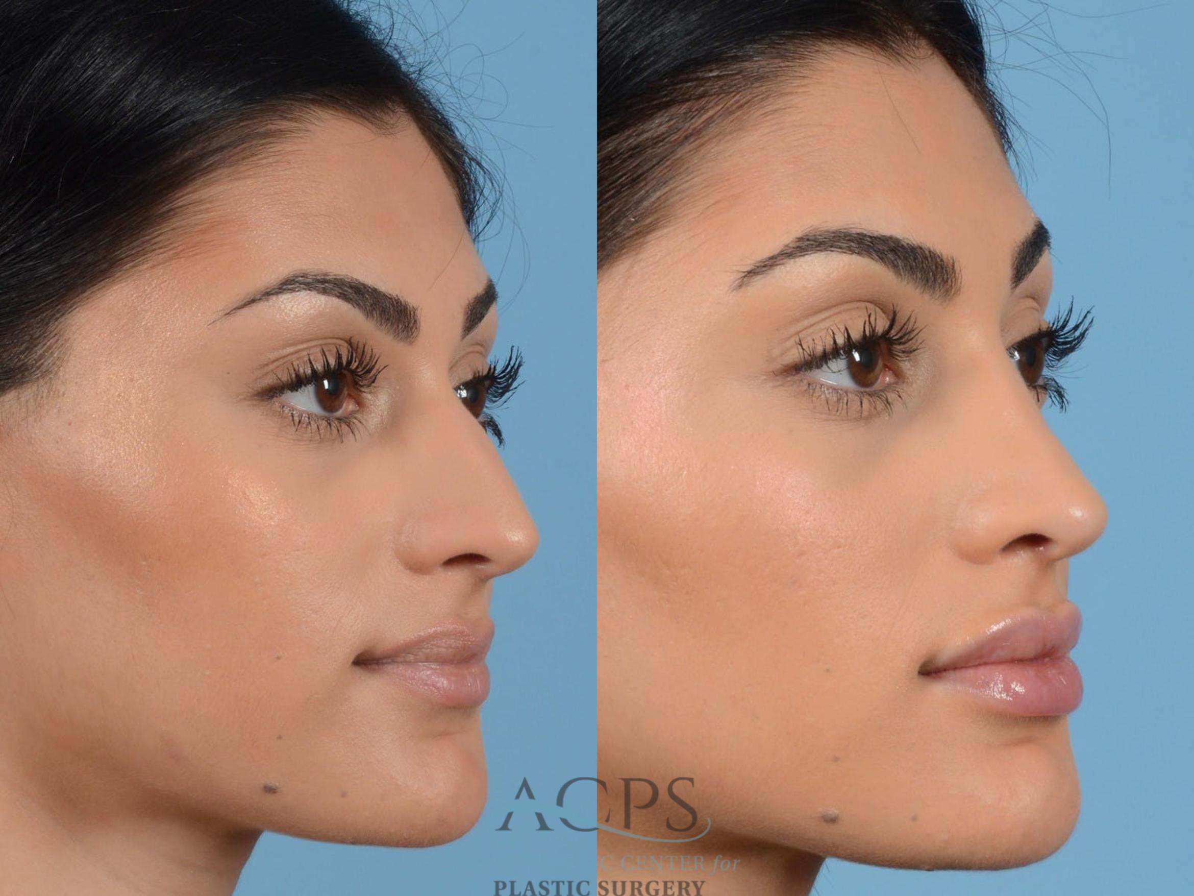 Before & After Rhinoplasty Case 1205 Oblique View: View in Houston, TX