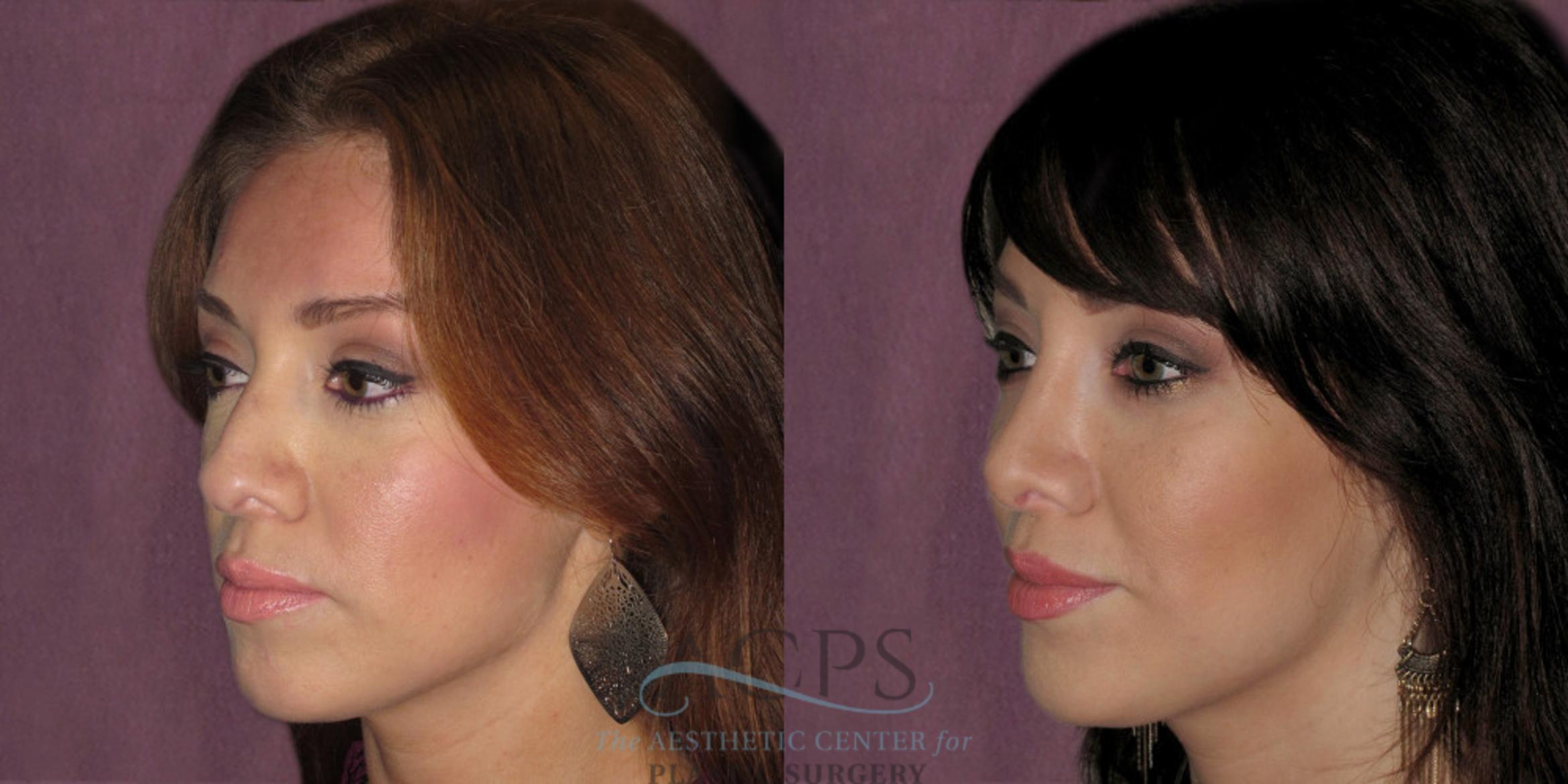 Before & After Rhinoplasty Case 1206 Oblique Left View: View in Houston, TX