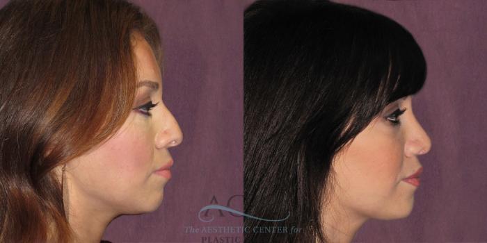 Before & After Rhinoplasty Case 1206 Side Right View: View in Houston, TX