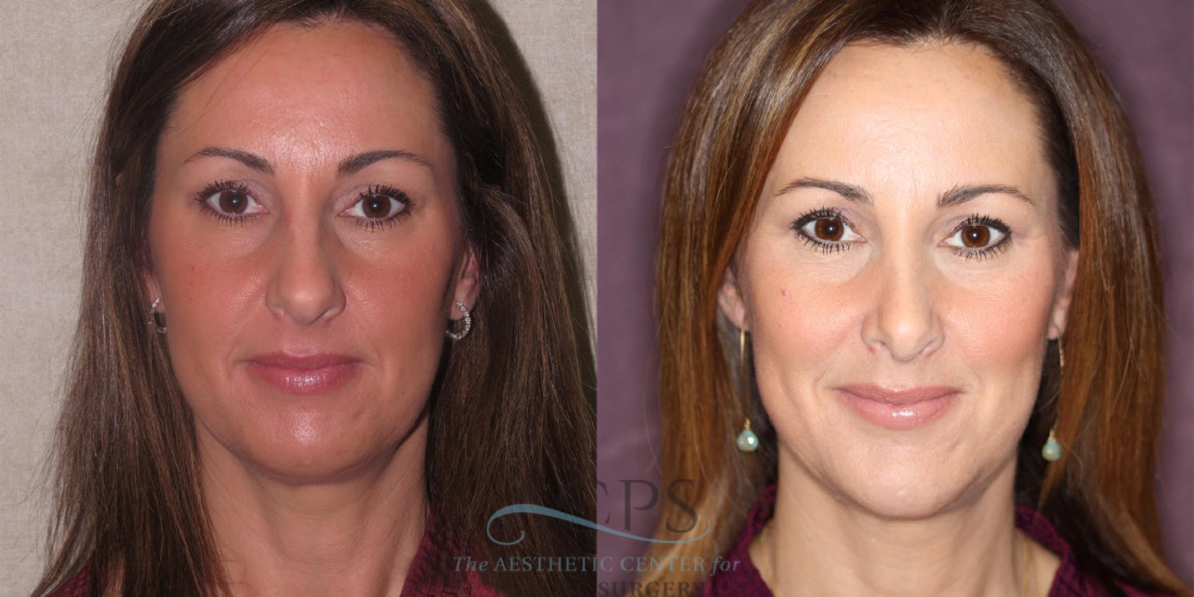 Before & After Chin Augmentation Case 1208 Front View: View in Houston, TX